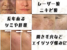 ビューティーワンド ココ(Beauty Wand COCO)