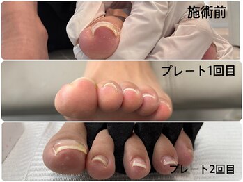 モア(moa)/巻き爪　巻き爪補正