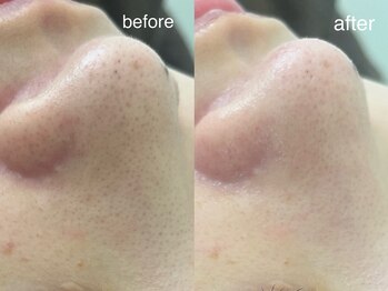 テオリア(TEORIA)/頑固な黒ずみ撃退☆