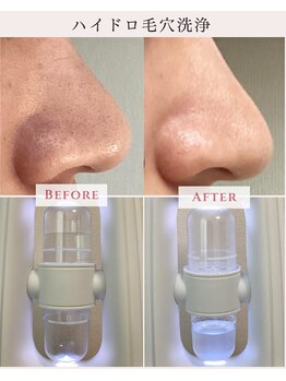 レクラ バイ ドクターエイチ(L'ECLAT by Doctor.H)/ハイドロ毛穴洗浄
