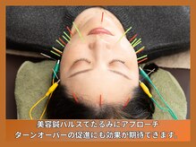 晴々の雰囲気（お身体、お悩みに合わせた鍼を行います！）
