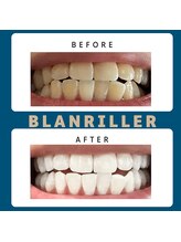 ブランリエ 天王寺阿倍野店/セルフホワイトニング