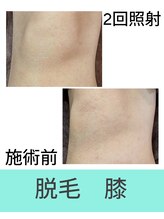 エミナル(EMINAL)/膝脱毛の効果！脱毛/全身脱毛/