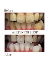ホワイトニングショップ 徳島藍住店/Before After美白ホワイトニング