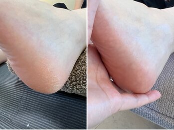 ガサガサ踵もスッキリ！