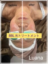 ルアナ(Luana)/BBL光トリートメントで美肌に！