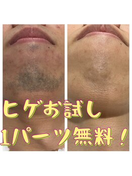 リアンジュ/ヒゲ脱毛の経過