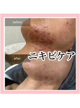 エクラーレ(Eclale)/ハーブピーリング症例集中コース