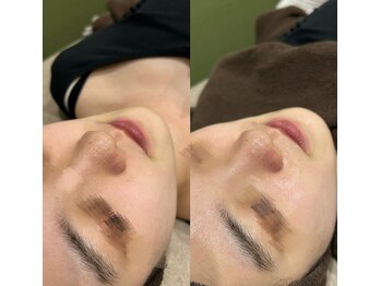 #美容革命ラボ 福岡春吉店/毛穴【春吉・天神・博多】