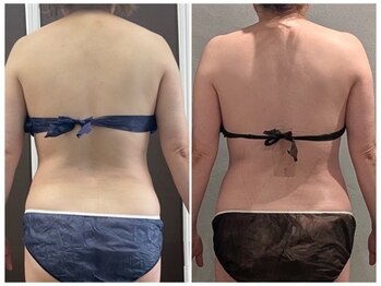 ツーアップ(2up)/背中の張り,肩こりスッキリ