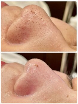 エクリュ(ecru)/毛穴汚れスッキリ