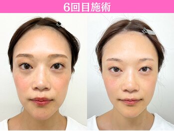 ナチュラルパーフェクトフェイス 新宿/6回目施術