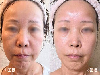 オラ(Ola)/40代/6回目・腸内遺伝子解析