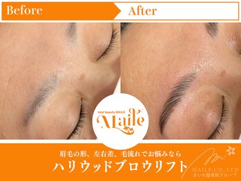 まいれ鍼灸院整骨院 整体院 草津院/ハリウッドブロウリフト/美眉