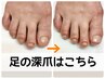 【足の深爪なおしたい!】☆特別価格☆足の深爪 即日見た目改善!