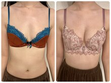 プリマ(prima)/バストアップ症例