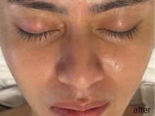 サロン ド エメ(salon de aimer)/【After】毛穴引き締まり透明感