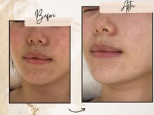 コンビンス(convince)/名古屋中区肌質改善美肌実績あり