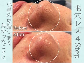 ネオファースト(NeoFirst)/詰まりも1回でここまで綺麗に♪