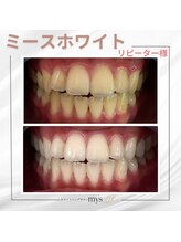 ミースホワイトニング(mys whitening)/ビフォーアフター【歯科提携】
