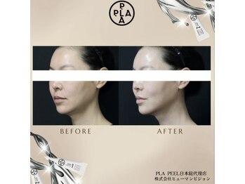 アドラーブル プレ葉ウォーク浜北店/プラピール　女性症例写真 1