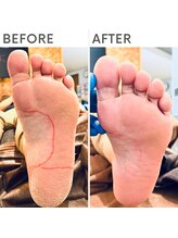 クオッカ(Quokka)/足裏のたこ・角質ケア