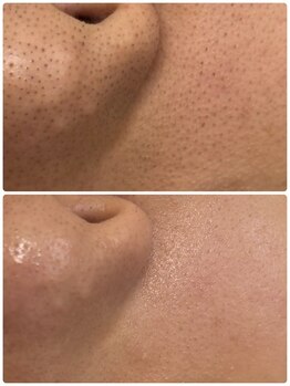 レイラニア(Leilani.Am)/マツヤニホットセラピー常在菌