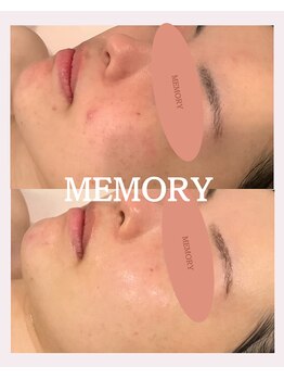 メモリー(MEMORY)/毛穴、ニキビがなめらかに♪