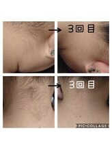 飛花(HIKA)/うなじ脱毛ビフォーアフター♪