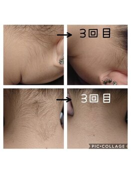 飛花(HIKA)/うなじ脱毛ビフォーアフター♪