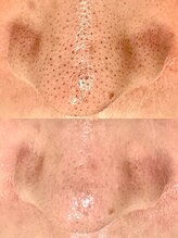 メンズエムボーテ 太田店(Men's M BEAUTE33)/【全顔毛穴洗浄】