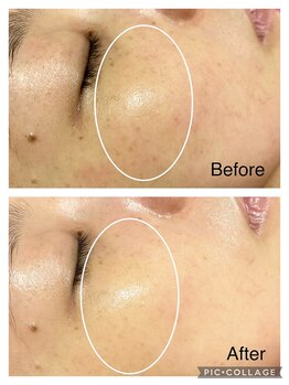 アンフィー 川西能勢口店(Une f`ee)/フォト美顔のビフォーアフター★