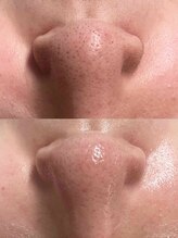 リッチ(Rich)/小鼻の産毛・毛穴黒ずみ悩み改善