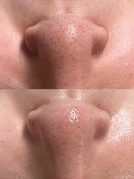 リッチ(Rich)/小鼻の産毛・毛穴黒ずみ悩み改善