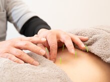 りふぁいん鍼灸整骨院 八王子北野店/鍼灸　局所コース（腰）