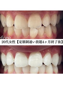 ホワイト 福岡博多店(WHITE)/ホワイトニングビフォーアフター