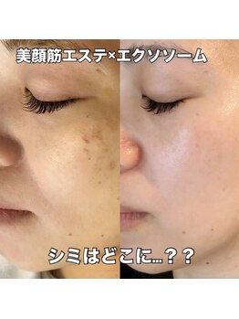 リエル(RIEL)/【美顔筋育成】