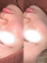 アクシア ビューティー サロン(AXSIA)/【REVIハーブピーリング】