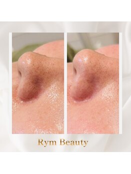 リム ビューティー(RYM BEAUTY)/毛穴ケアや毛穴引き締めにも
