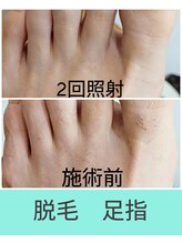 エミナル(EMINAL)/足指脱毛の効果！ 脱毛/毛穴
