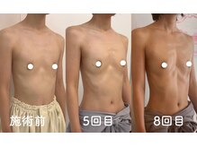 エミュボディ 青山本店(emu body)/バストアップ写真　乳房リリース