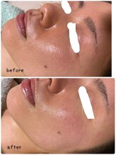 プレジール(Plaisir)/ハーブトリートメントでシワ改善