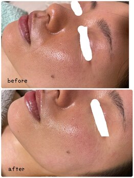 プレジール(Plaisir)/ハーブトリートメントでシワ改善