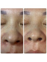 スキンラボ カホクカイ(KaHokuKai)/１回/4週　２回目