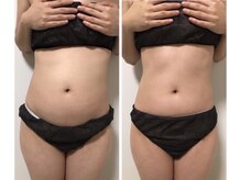 リハーツ(RE;heartz)/★－４℃脂肪冷却★ダイエット！