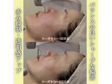 ハニエル(Haniel)/カーボキシー症例