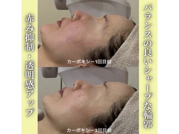 ハニエル(Haniel)/カーボキシー症例