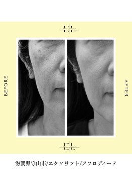 アフロディーテ(Aphrodite)の写真/医師監修メニューエクソリフトで根本の肌改善！シワ・たるみケア/ハリ/リフトアップ/小顔◎理想の美肌に♪