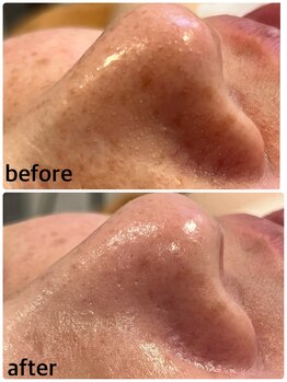 プロッソル こころ(PROSOL)の写真/頑固な黒ずみ・角栓をケアして、透明感あふれる素肌へ♪