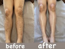 ソーレエルーナ(SOLE e LUNA)/メンズ 脱毛 新宿 ワックス 光